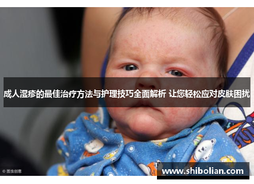 成人湿疹的最佳治疗方法与护理技巧全面解析 让您轻松应对皮肤困扰